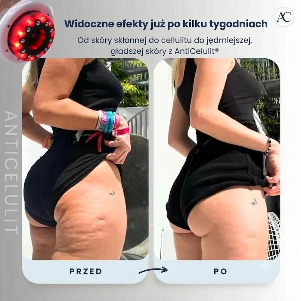 Masażer AntyCelulit